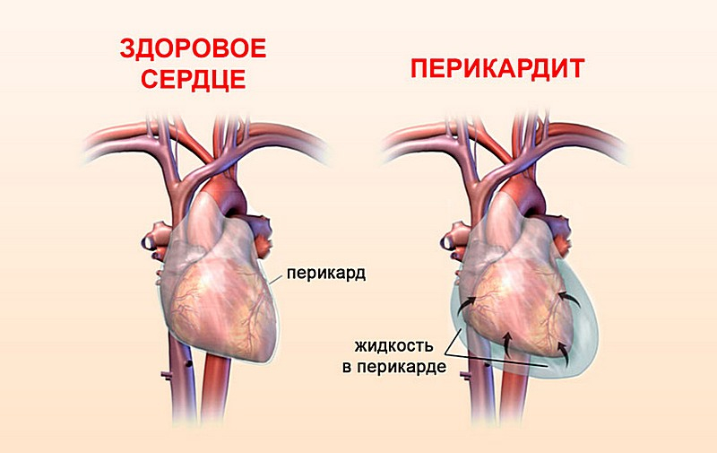 болит сердце симптомы